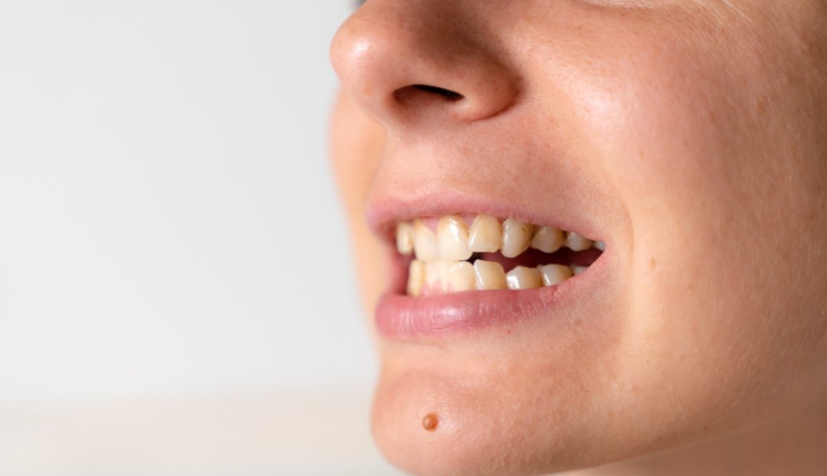 Tenho piercing na língua, posso colocar aparelho nos dentes?