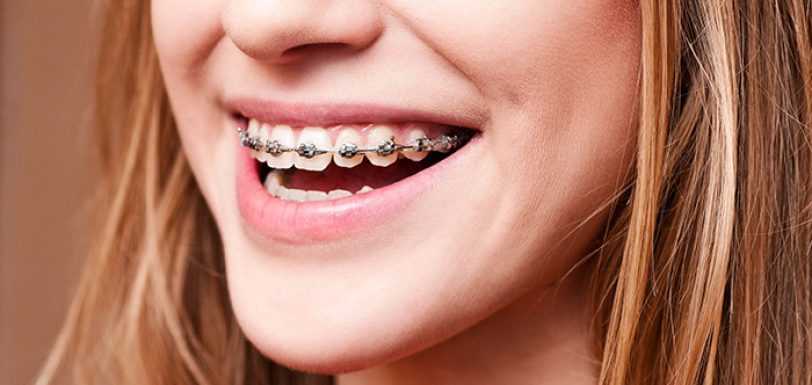 braces_and_pain