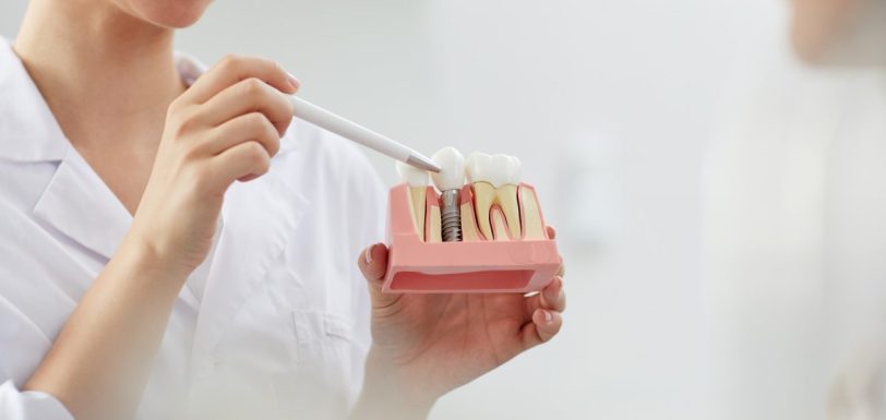 implantes dentários com carga imediata