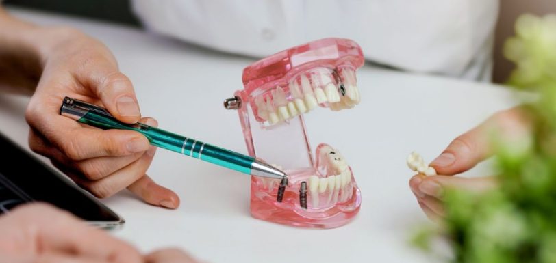 pino de implante dentário preço