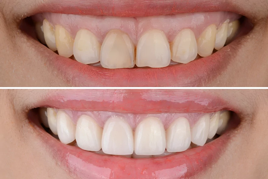 lente no dente antes e depois