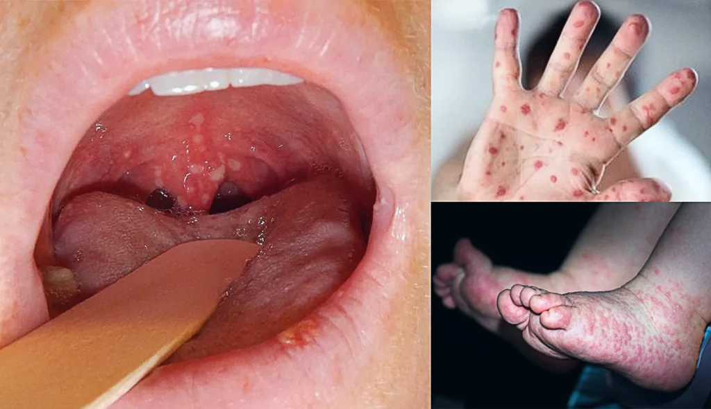 herpangina: imagens de feridas no fundo da boca, em mão e em pés