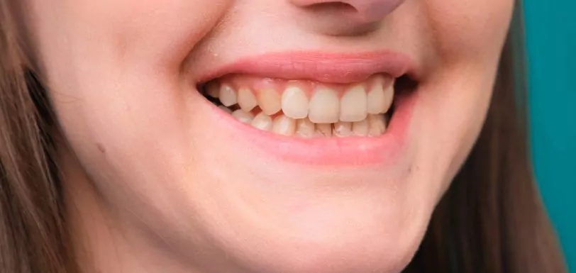 fluorose dentária