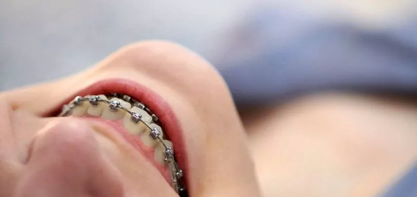 dentes tortos e encavalados