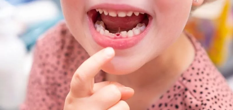 troca de dente de leite